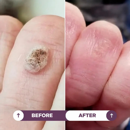 Seralia | Wart-Removal Pen