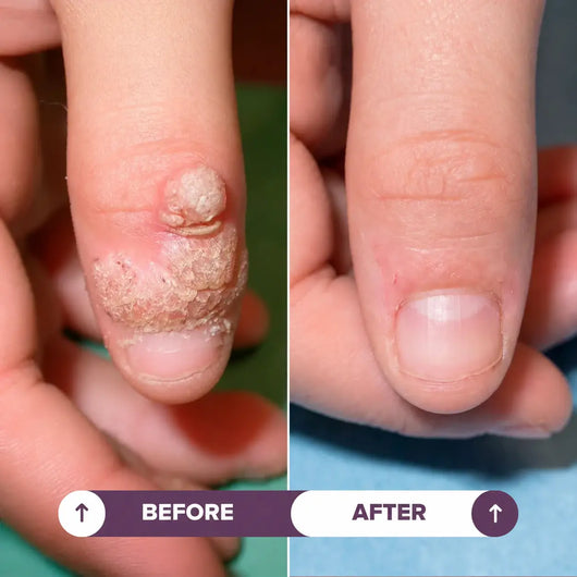 Seralia | Wart-Removal Pen